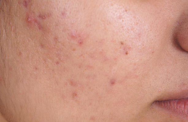 Ayurvedic home remedies for acne