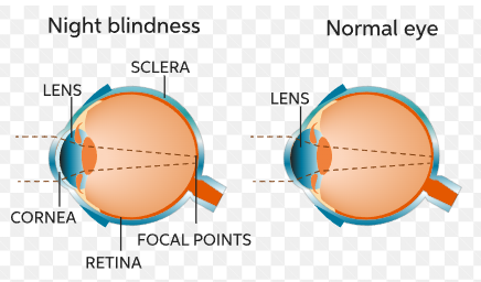 causes of night blindness