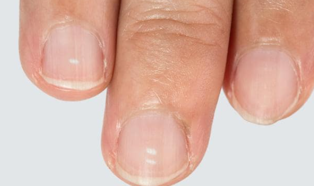 signs of vitamin deficiency in nails