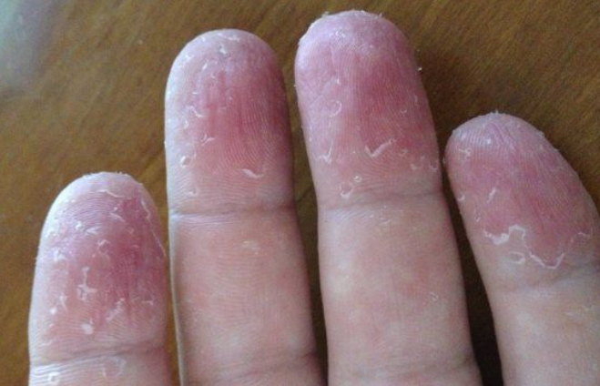 peeling skin on fingers vitamin deficiency