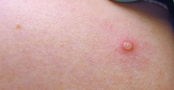 symptoms of monkeypox virus